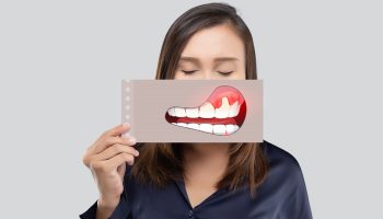 Scaling and Root Planing for A Gummy Smile