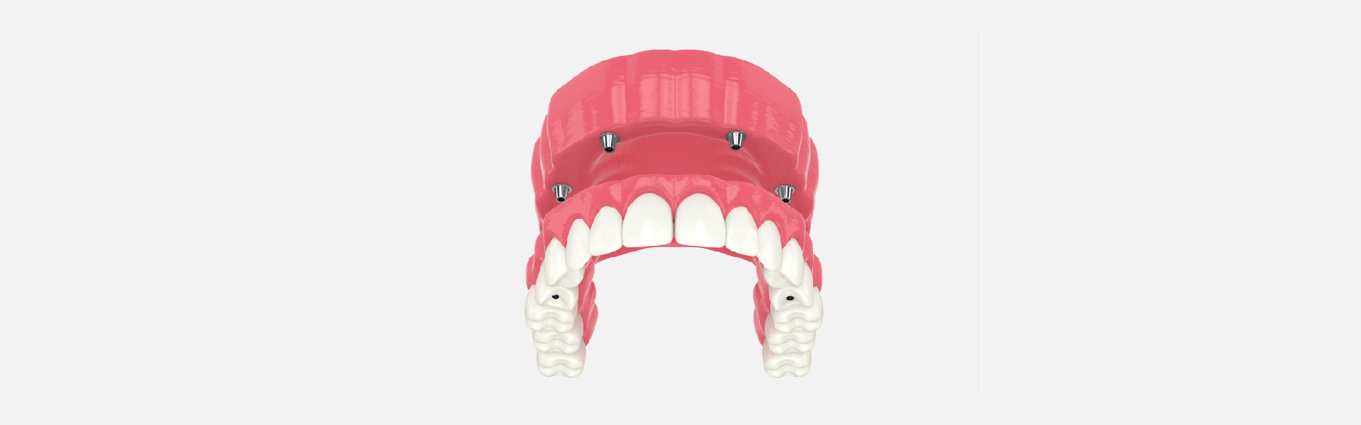 All-on-4 Implants Vs. Traditional Dentures: Which Is Suitable for You?