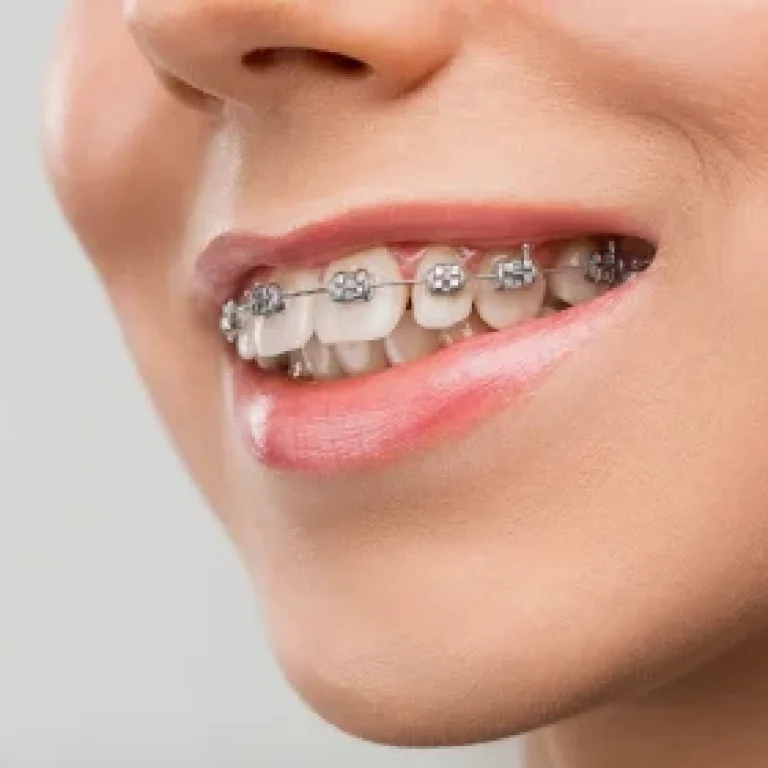 Aligners and Composite Bonding